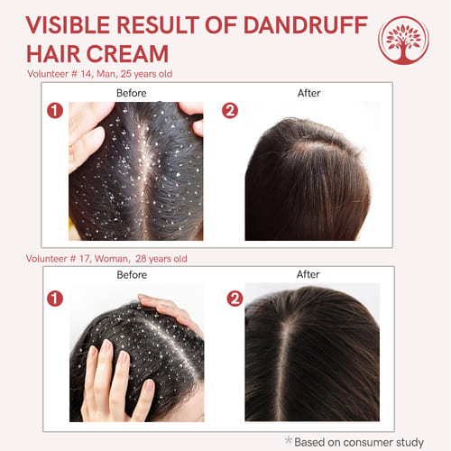 Ivory Natural Dandruff Hair Cream Before After Image