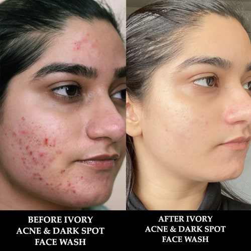 before and after use of Acne & Dark Spot Face Wash