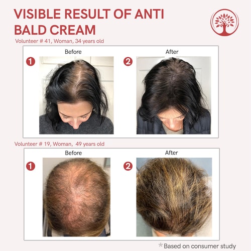 visible result of hair growth cream for bald spots
