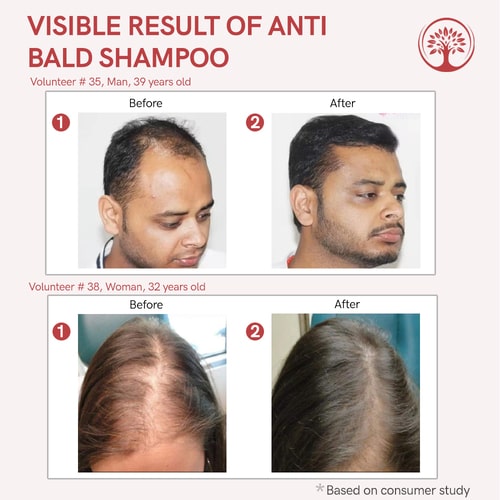 before and after use of Ivory natural best shampoo for bald men