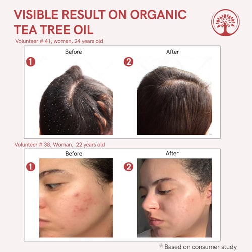 Visible result of tea tree for pimples
